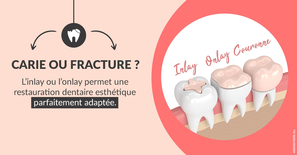 https://dr-sfedj-thierry.chirurgiens-dentistes.fr/T2 2023 - Carie ou fracture 2