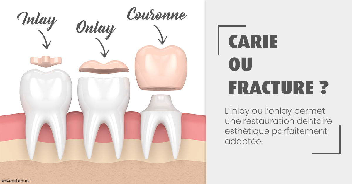 https://dr-sfedj-thierry.chirurgiens-dentistes.fr/T2 2023 - Carie ou fracture 1