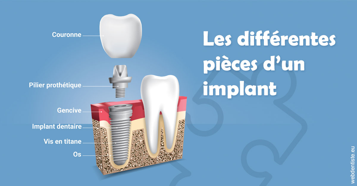 https://dr-sfedj-thierry.chirurgiens-dentistes.fr/Les différentes pièces d’un implant 1